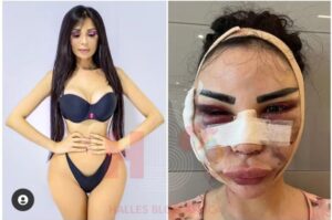 Jennifer Pamplona, A former Versace model who has went extra mile to transform herself into Kim Kardashian look-alike, which cost nearly $600k on surgeries has now folked out $120k to change back to original looks.