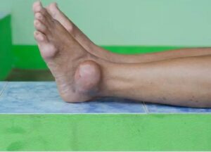 Causes and Treatment Of Rheumatism