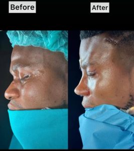 "Thanks for Giving Me My Dream Nose" – Skitmaker Zics Aloma Undergoes Facial Surgery in Turkey