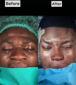 "Thanks for Giving Me My Dream Nose" – Skitmaker Zics Aloma Undergoes Facial Surgery in Turkey